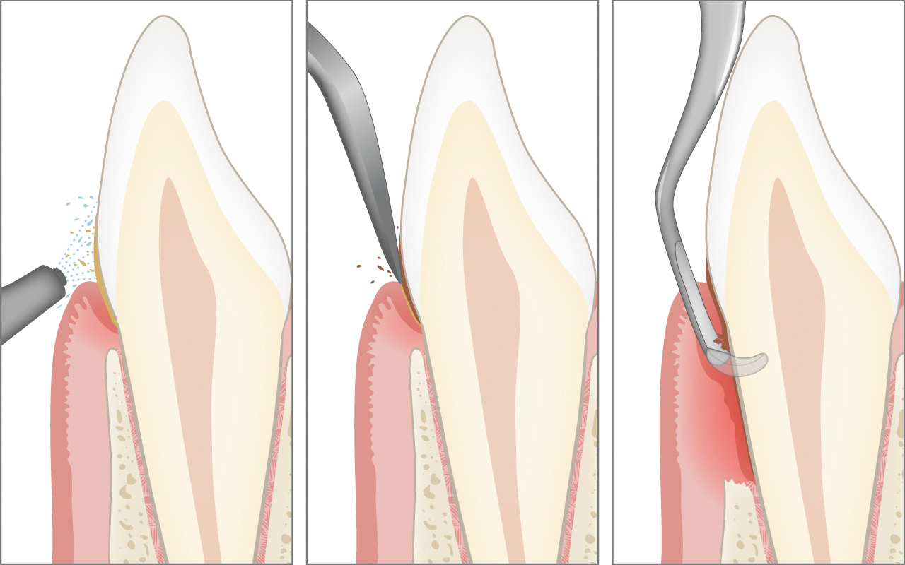 Pulizia professionale dei denti