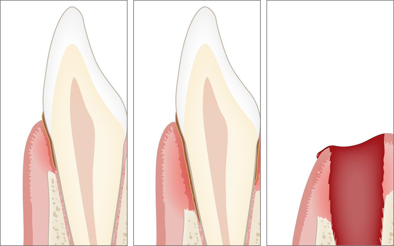 Altre conseguenze: perdita ossea, tasche gengivali e perdita dei denti